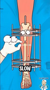 How Leg Lengthening Surgery ACTUALLY Works 😱 #shorts #science