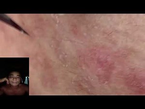 Extreme Acne & Pimple Popping Compilation – Blackhead & Cyst Removal @88410 400_FHD
