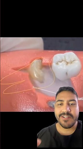 EXTRAÇÃO DE SISO SEMI-INCLUSO #dente #siso