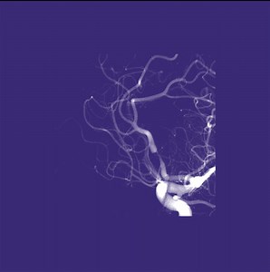 MRA and Flow MRI: Fresh Blood Imaging (FBI) MRA | e-MRI