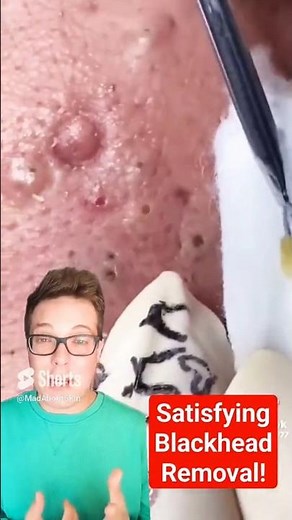 BLACKHEAD REMOVAL OF THE YEAR 2025 - You Cant Beat This #shorts