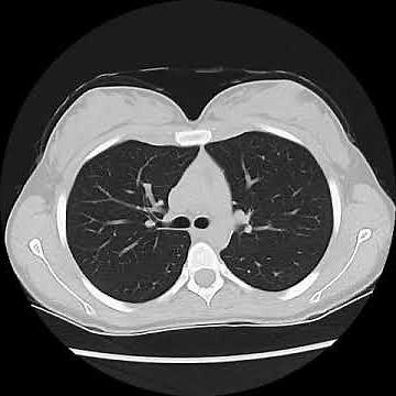 Normal Chest CT - using "lung windows"