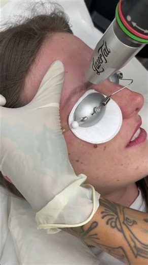 Eyebrow Tattoo Removal done in seconds 💕