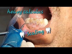 Scaling and cleaning, remove calculus heavy tartar from teeth and gum line by ultrasonic cavitron