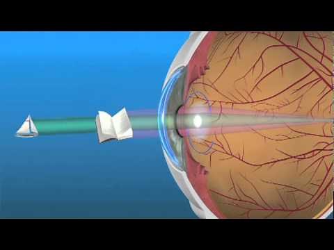 Multifocal Lens (IOL)