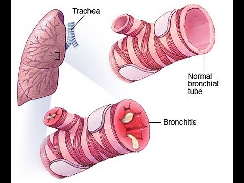 Bronchitis (PEV)