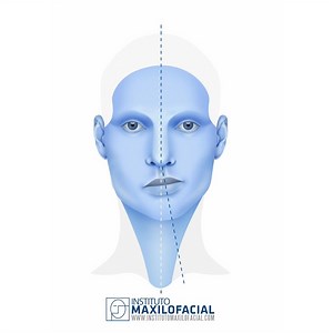 La asimetría facial es una alteración que se define por la presencia de una disarmonía entre ambos lados de la cara. Esto es, en el plano vertical frontal de la cara, uno de los dos lados se muestra descompensado respecto el otro. Aunque una asimetría facial leve no patológica es en muchos casos imperceptible y a menudo se considera normal, su importancia clínica no puede determinarse fácilmente, ya que la estética facial es completamente subjetiva. Por lo tanto, el grado de aceptación de esta m
