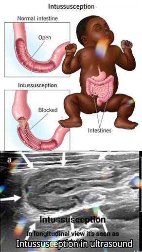 🔍 Intussusception on Ultrasound | Target Sign Explained in Seconds! #ultrasound #baby