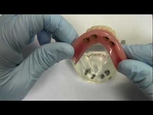 4-Implant Ball Attachment Overdenture - Model Demonstration