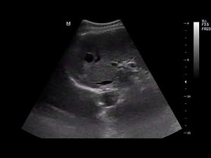 CASE 1084 ADPKD autosomal dominant polycystic kidney disease
